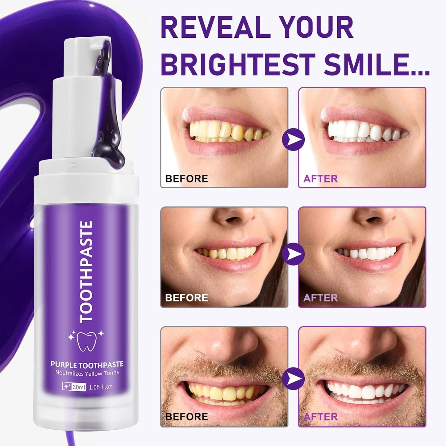 Smile transformation image after using Purple Teeth Whitening Toothpaste for a few weeks.